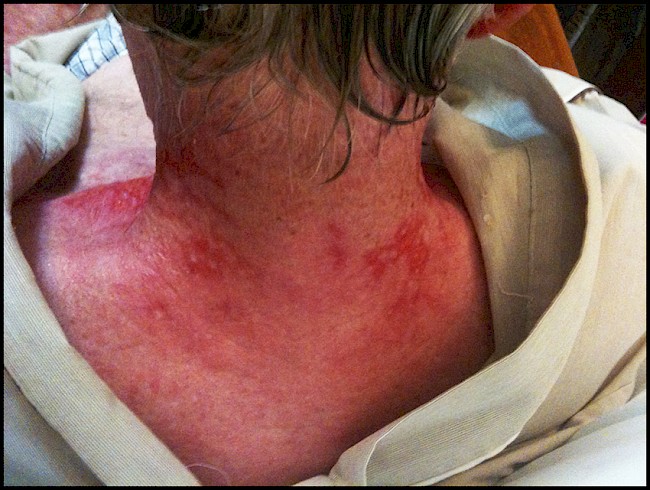5. Burns from radiation therapy (the hair on his upper neck never grew back), 1 June 2012
